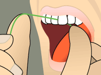 flossing diagram