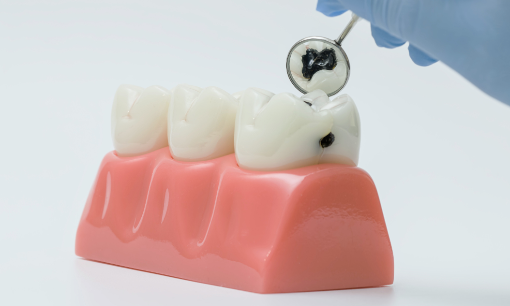 How long does it take for a cavity to form on a tooth model