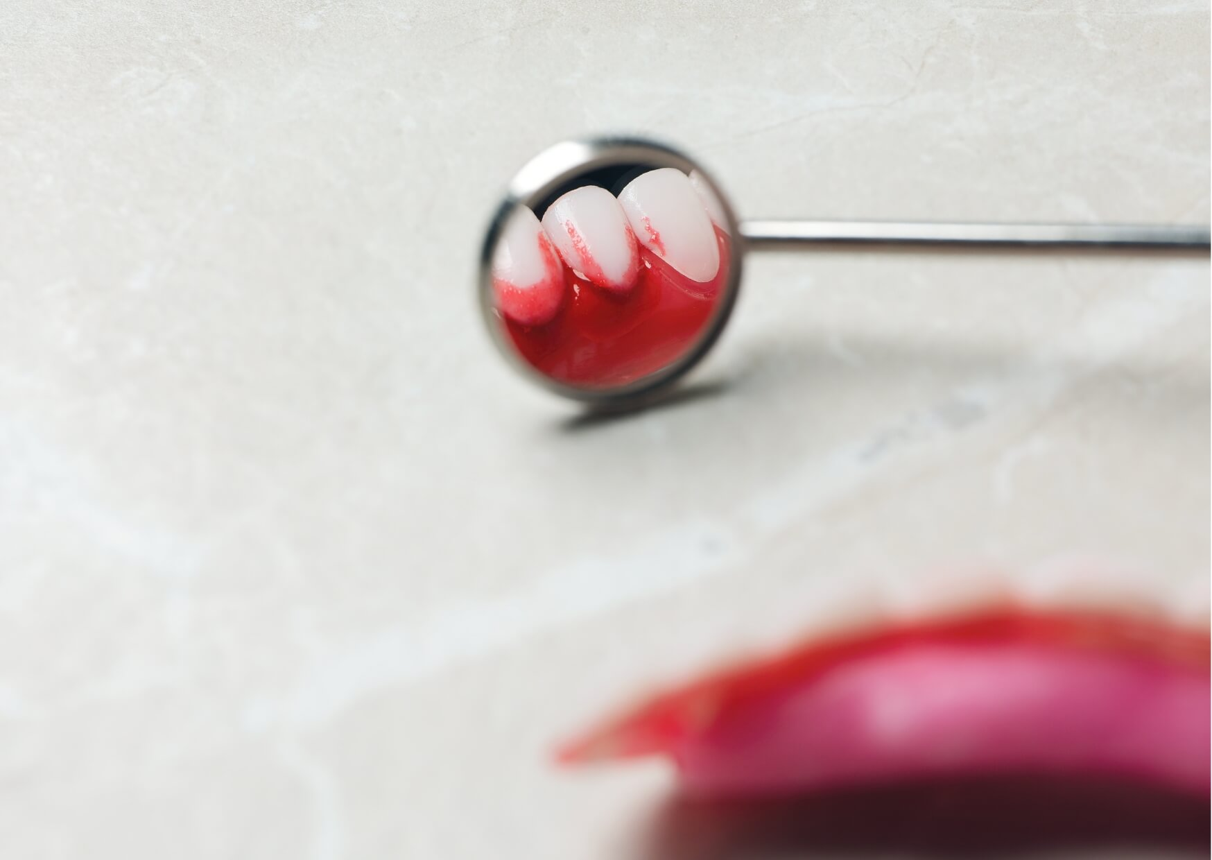 Close-up of red, swollen gums reflected in a dental mirror, illustrating common gingivitis symptoms such as gum inflammation, tenderness, and bleeding along the gumline.