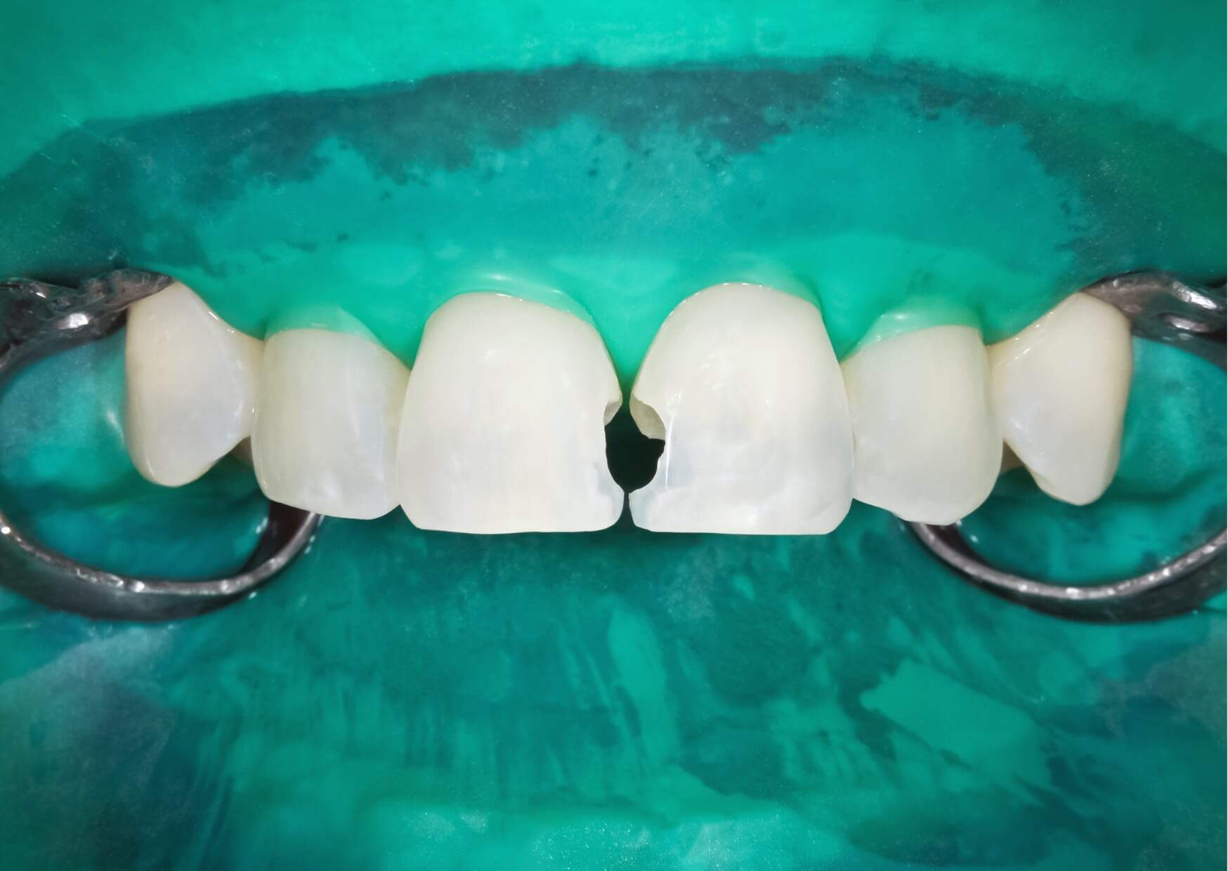 Close-up of a front tooth with a visible crack and broken edge, showing what a cracked tooth looks like.
