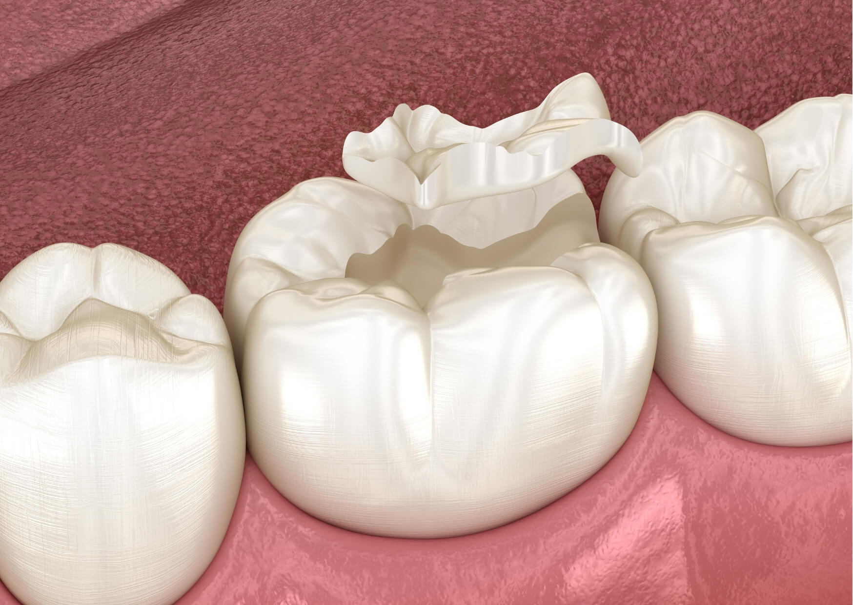 Illustration of a chipped tooth with a broken section of enamel, showing the appearance of a tooth chip.