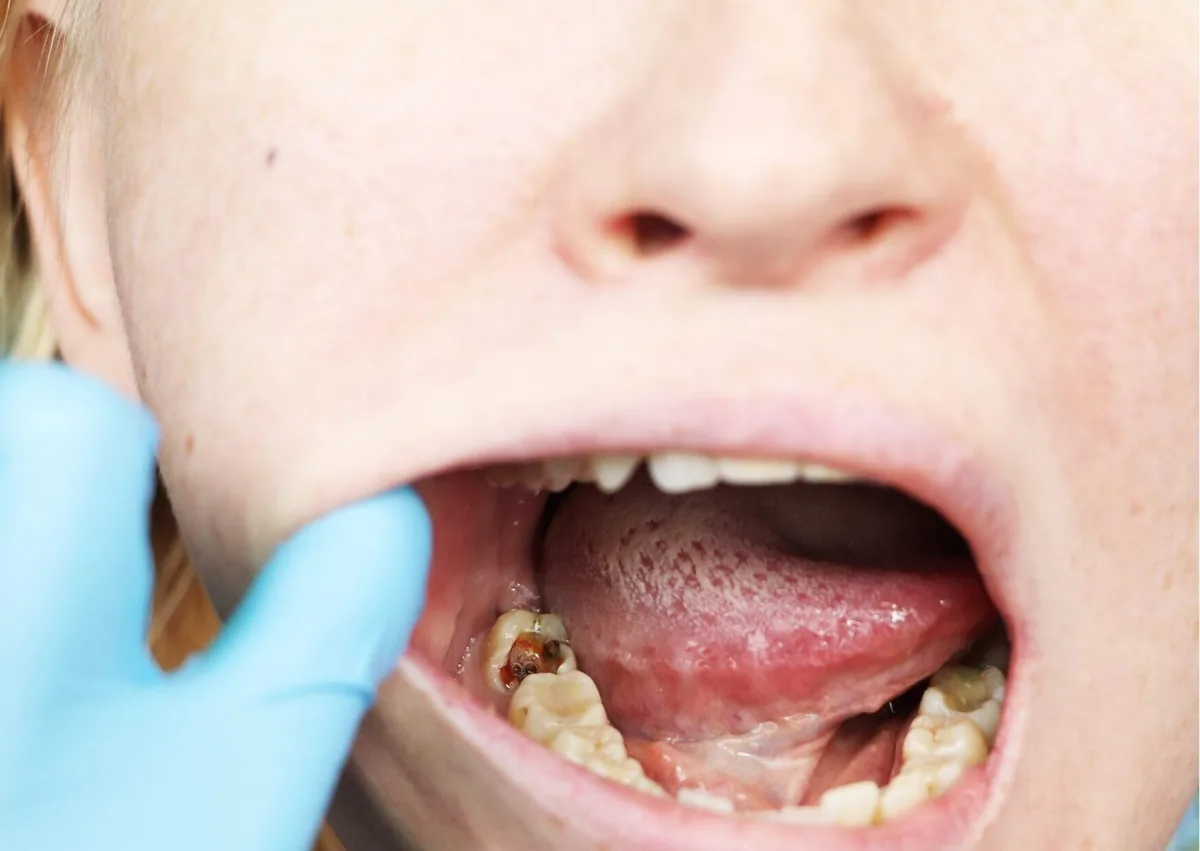 Close-up of a back tooth with a dark, visibly decayed area showing what a cavity can look like.