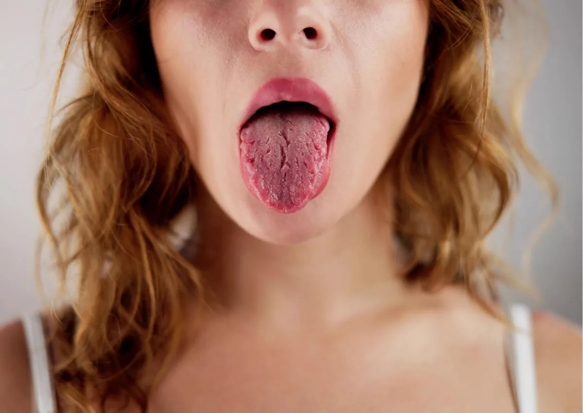Close-up of a person’s tongue illustrating symptoms commonly associated with dry mouth.