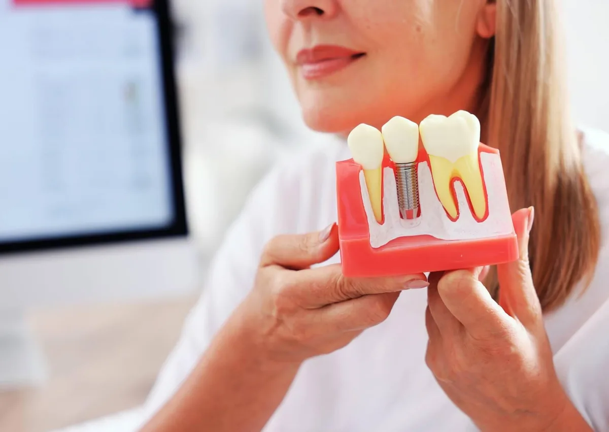 Dental implant model showing how affordable dental implants can replace a missing tooth and restore a smile.
