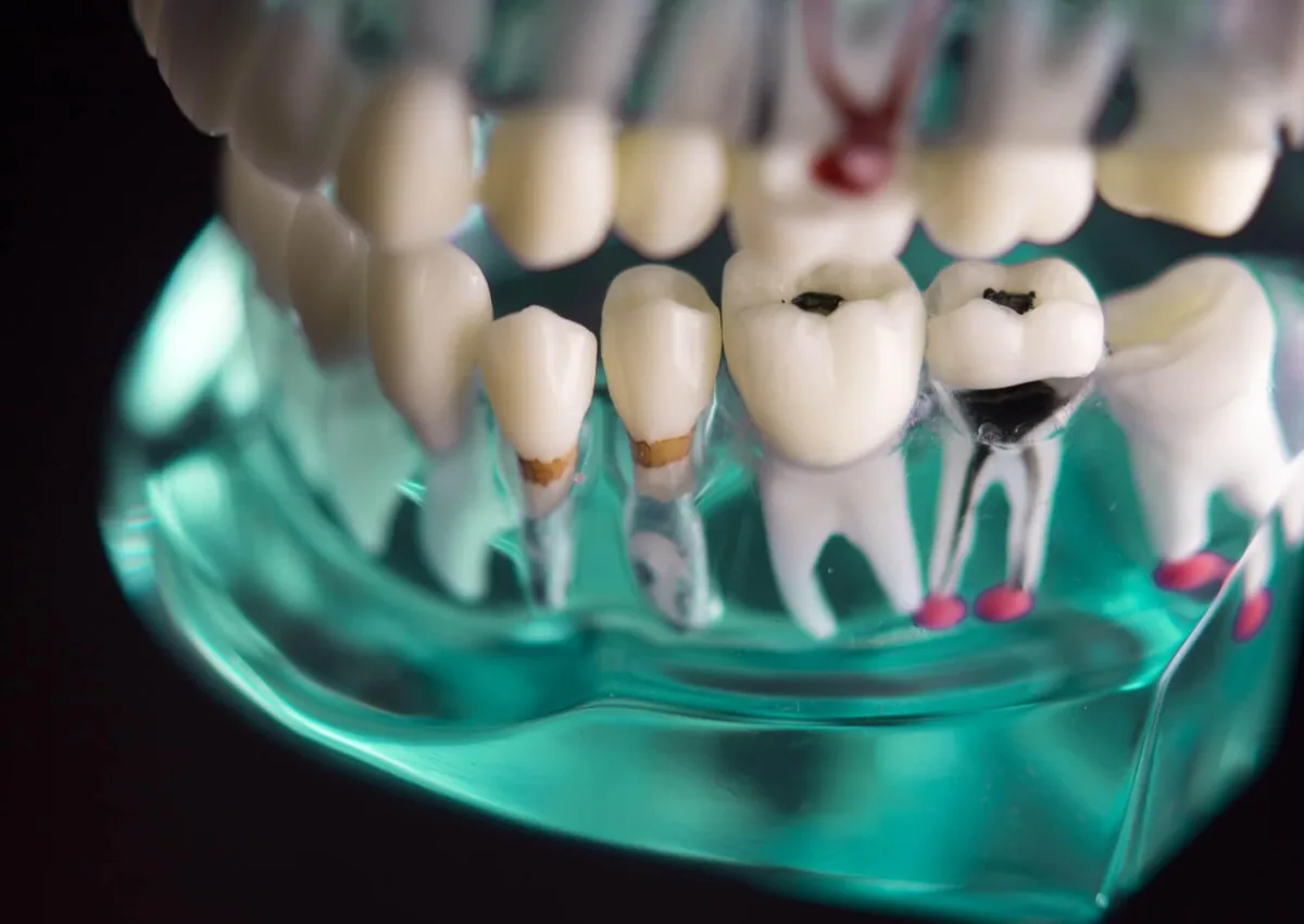 Dental model showing plaque and tartar buildup on teeth before professional plaque removal.